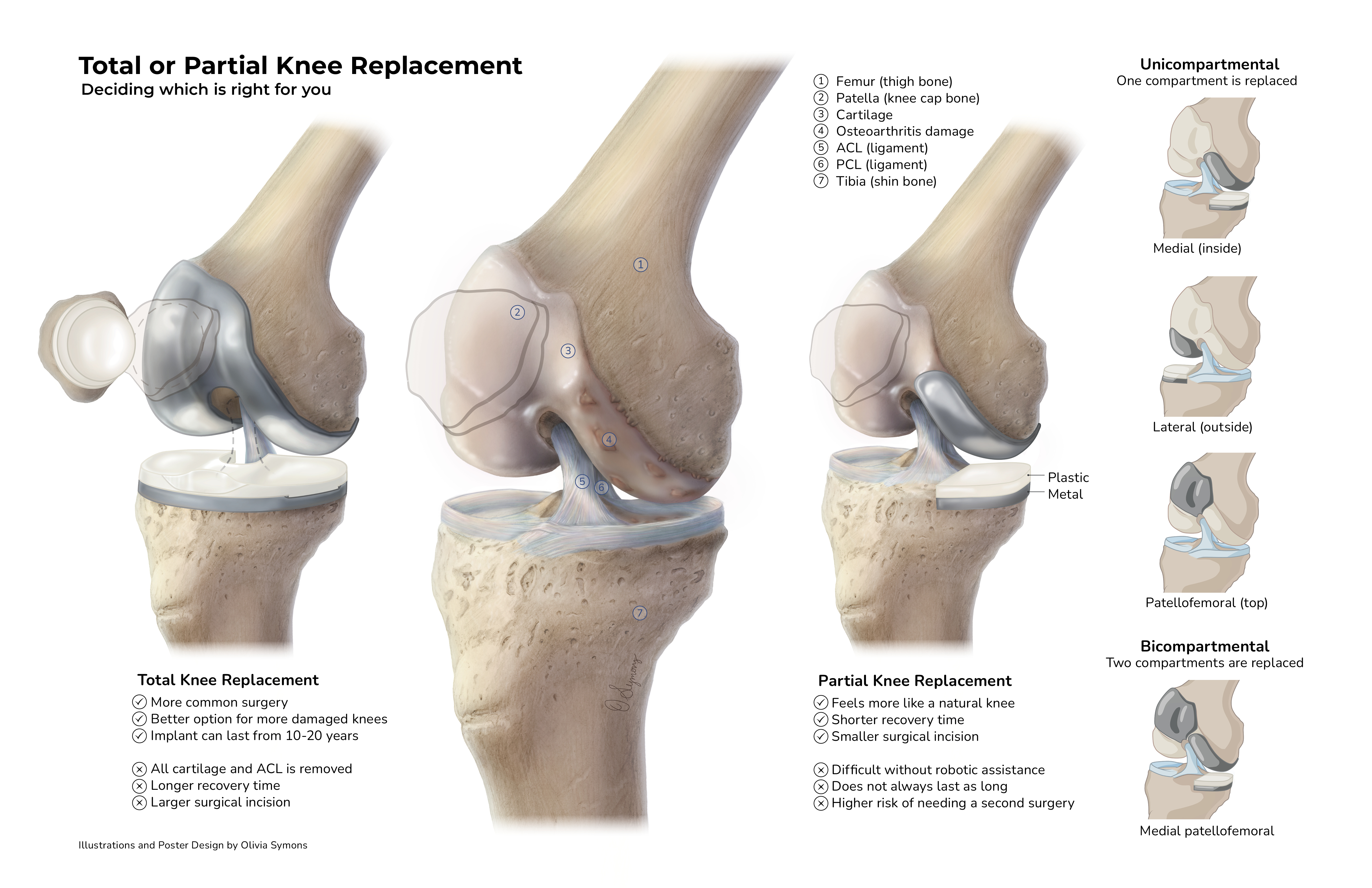 A scientific illustration of knee replacements.